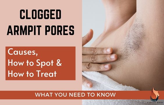Clogged Armpit Pores: Causes, How to Spot & Treat
