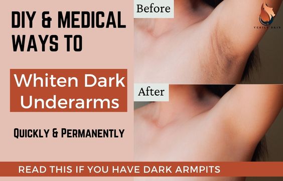 DIY & Medical Ways to Quickly Whiten Underarms Permanently
